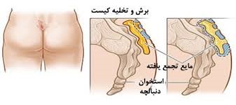 درمان کیست مویی یا پیلونیدال با دارو یا جراحی درمان کیست مویی یا پیلونیدال با دارو یا جراحی