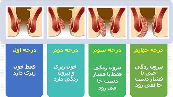 شرح انواع درجات بیماری بواسیر یا هموروئید