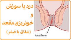 شقاق یا فیشر ودرد و سوزش بعد از دفع مدفوع شقاق یا فیشر ودرد و سوزش بعد از دفع مدفوع