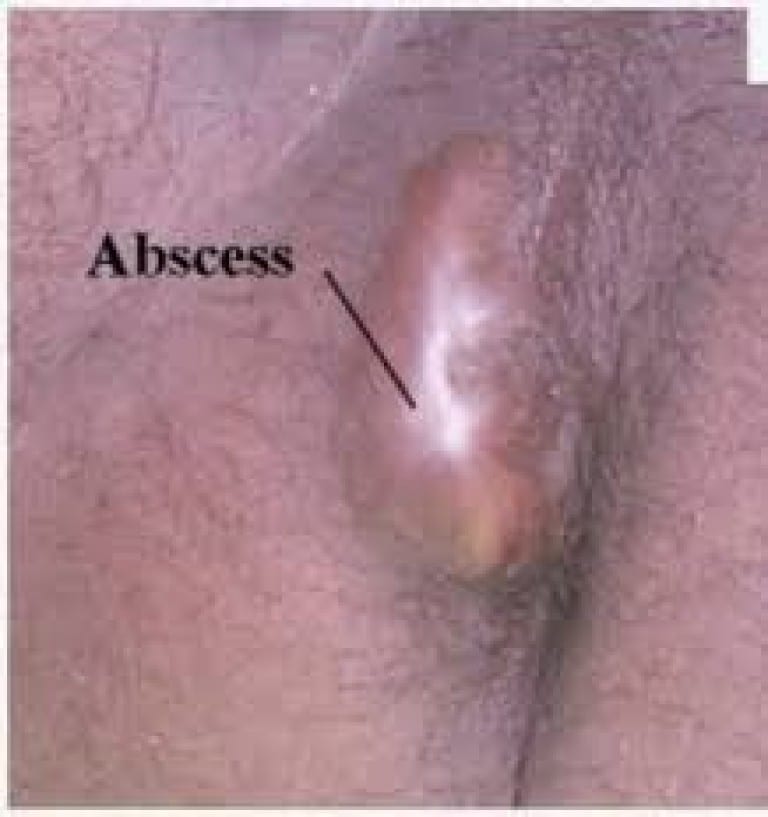 pictures-of-anal-abscess-masturbation-good-or-bad