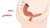 علت زخم مقعد چیست؟ علائم و روش های درمان آن