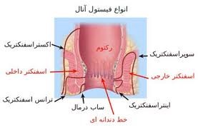 فیستول چیست