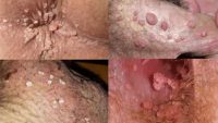 علت زگیل تناسلی در زنان و مردان چیست؟ چه علائمی دارد و چگونه درمان می شود؟