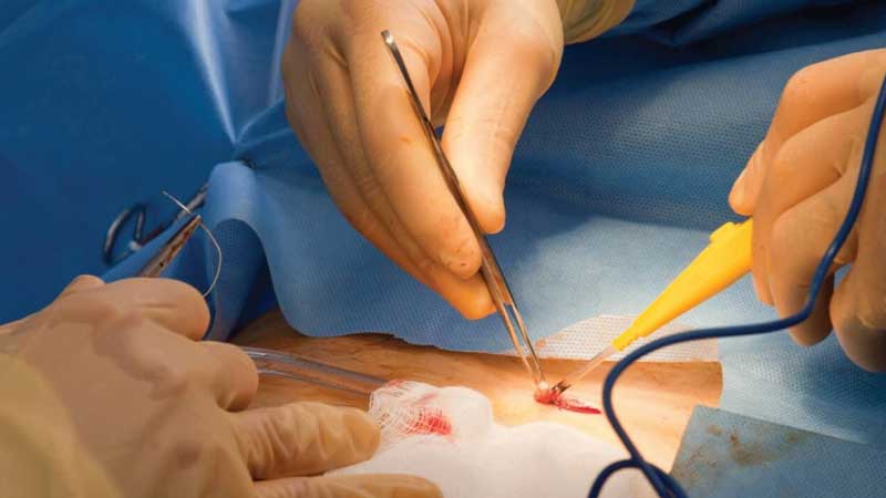 جراحي كيست مويي به چند روش انجام مي‌شود؟
