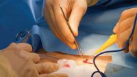عمل سرپایی کیست مویی؛ و جراحی باز و بسته سینوس پیلونیدال
