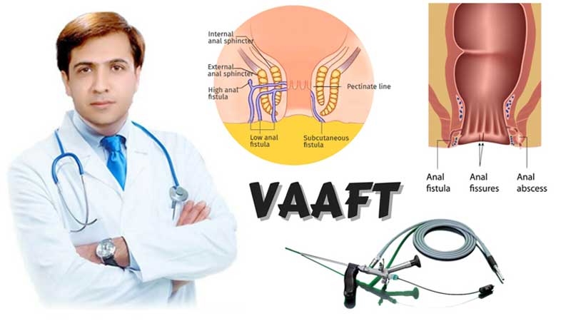 استفاده از روش vaaft برای درمان فیستول