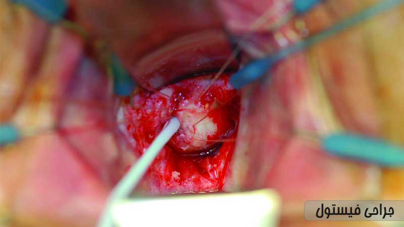 ۶ روش عمل جراحی فیستول مقعدی؛ مراقبت‌های بعد از عمل