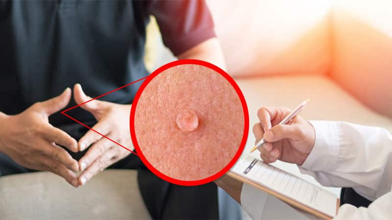 بهترین درمان زگیل تناسلی با لیزر و کرایو، در یک جلسه