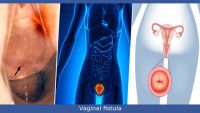 تشخیص بیماری فیستول در زنان یا فیستول واژن و راه‌های درمان