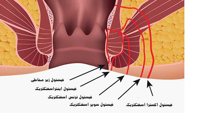 انواع بیماری فیستول