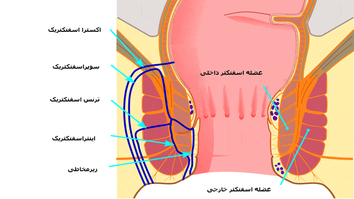 انواع فیستول مقعدی