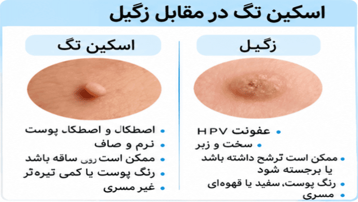 تفاوت زگیل و اسکین تگ