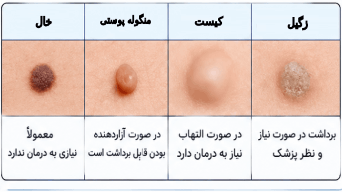 شکل اسکین تگ در ناحیه تناسلی