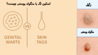 اسکین تگ تناسلی زنان و مردان؛ تفاوت آن با زگیل تناسلی(همراه عکس)